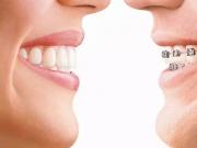 牙齿矫正的最佳年龄