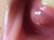 口腔内壁为何长突起的肉