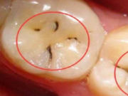 牙齿上小黑点应急早治疗